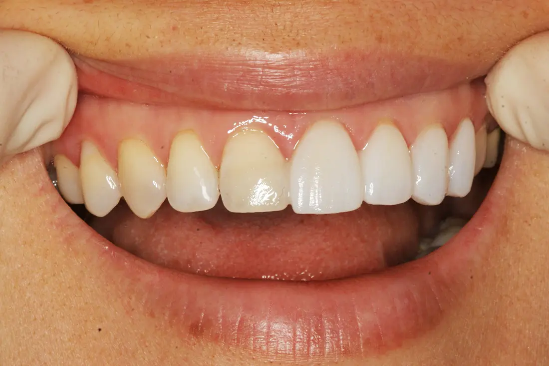 What to Look for in a Veneer Dentist in Agoura Hills