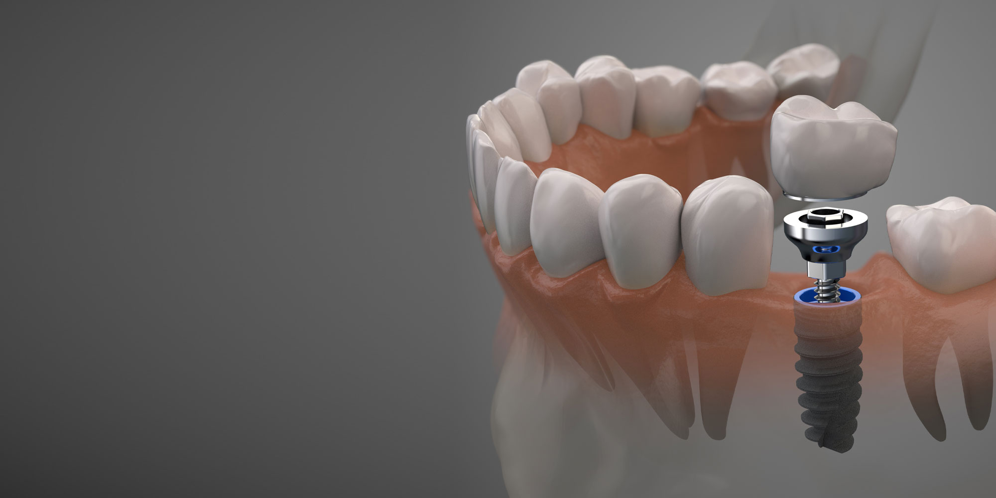 Implant in Agoura Hills