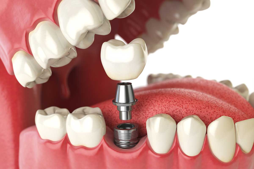 Implants in Agoura Hills