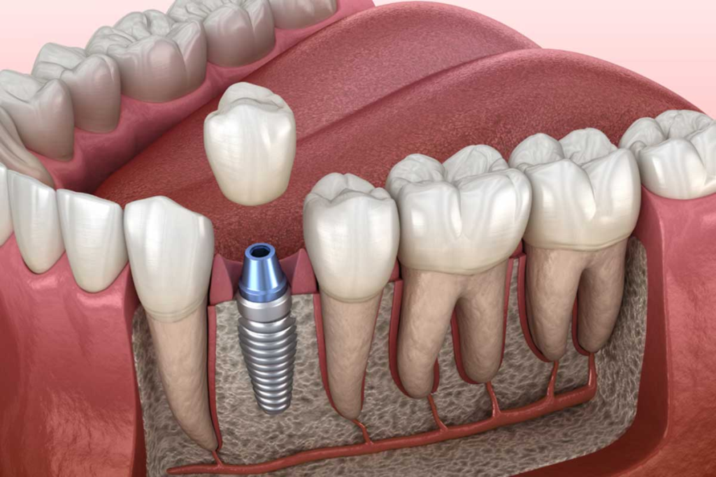 Dental implants in Agoura Hills